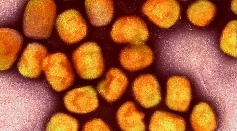 Half Of Canadians Concerned About Monkeypox: Survey