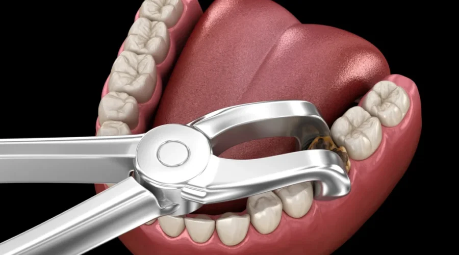 I had a tooth removed…and the moderate sedation….changed my world!! LOL